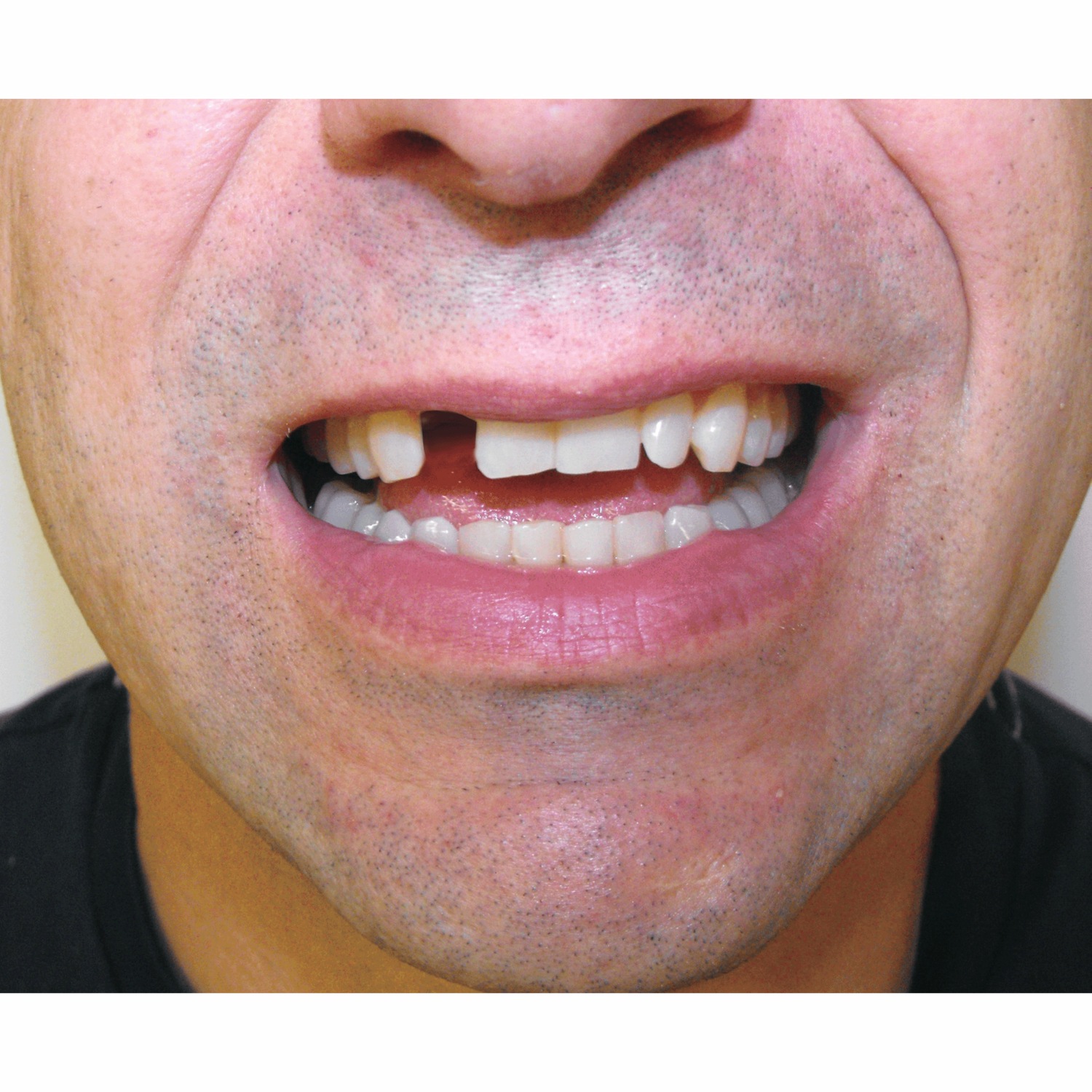 SMILE Mutazu Premium Headlight Assembly for Kawasaki Ninja ZX6R ZX636